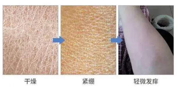 化妝品,皮膚,保濕,皮膚干燥,成分,角質層